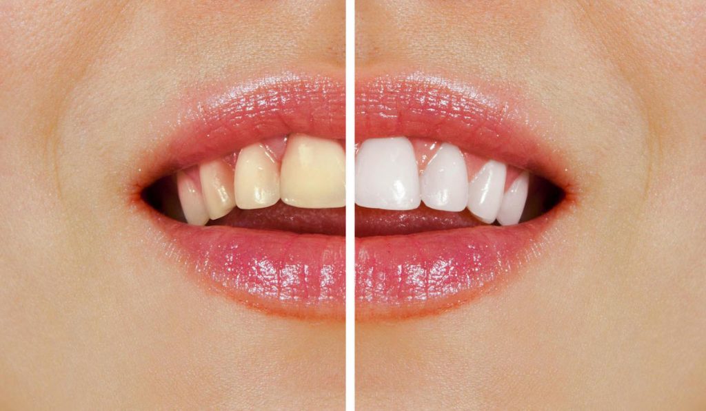 Warrnambool-Dentist-Tips-Over-the-Counter-vs-Professional-Teeth-Whitening
