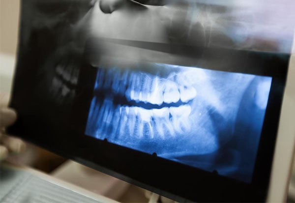 bone grafting in warrnambool