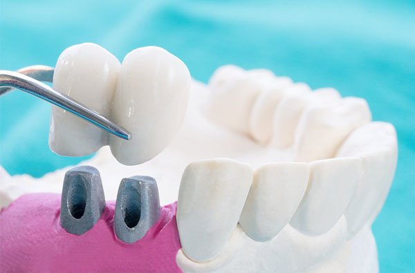 dental crowns in warrnambool