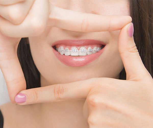 how do i know if i need braces warrnambool