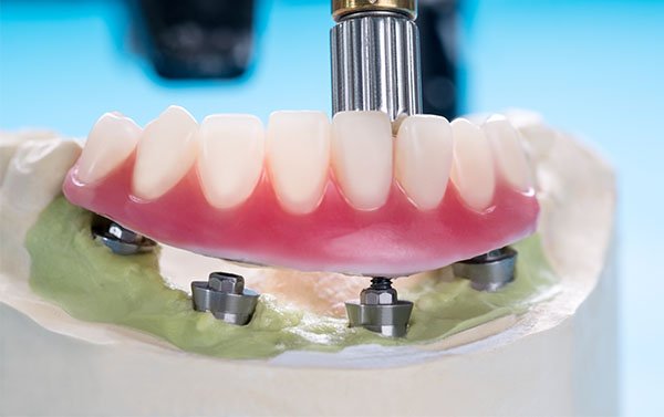 implant dentures in warrnambool