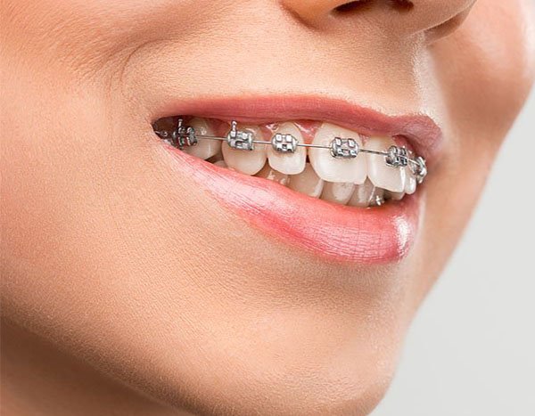 Orthodontics Warrnambool - Warrnambool Dental