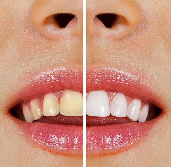 teeth whitening in warrnambool