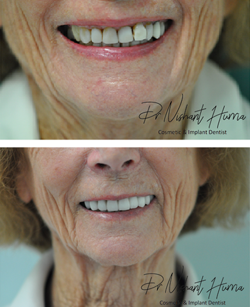 Anterior Crowns Veneers and Bridge warrnambool