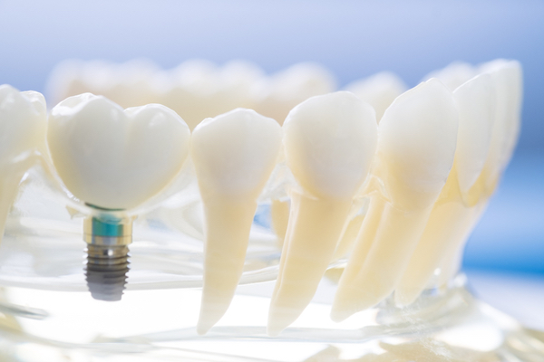 dental implants warrnambool