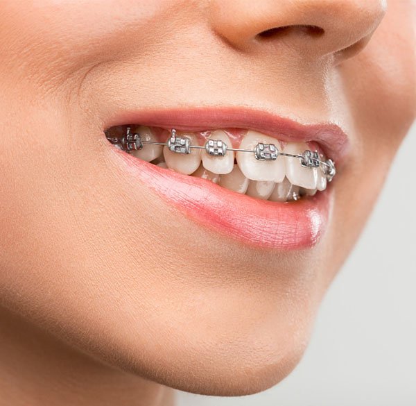 orthodontics warrnambool