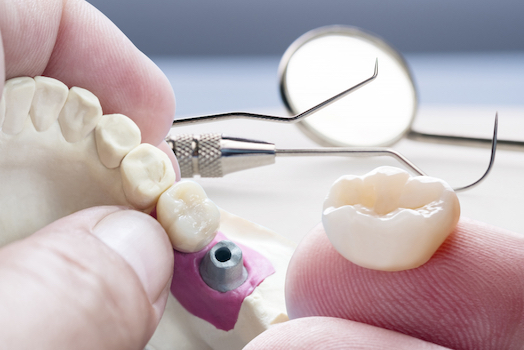 dental crown lost or damaged warrnambool