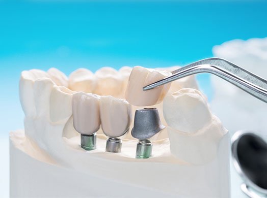 cerec crowns complaints