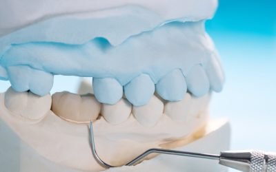 How Long Will Dental Crowns Last? Answers from Warrnambool Dental