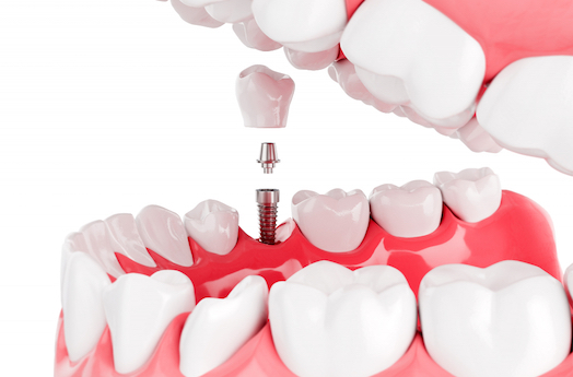 the dental implant process warrnambool
