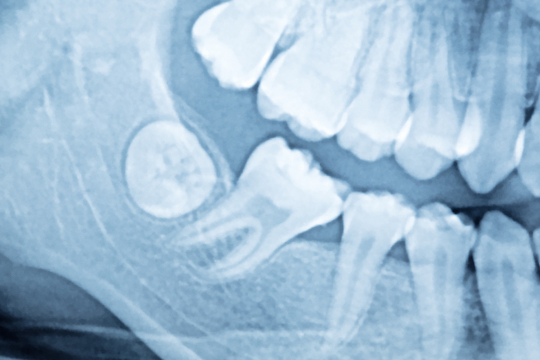 wisdom teeth removal process warrnambool