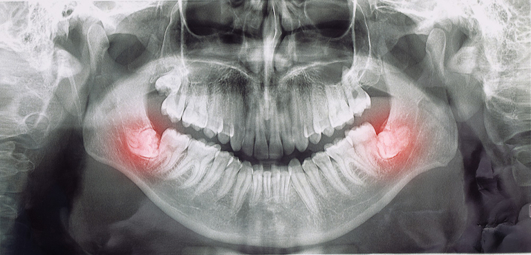 wisdom tooth extraction in warrnambool