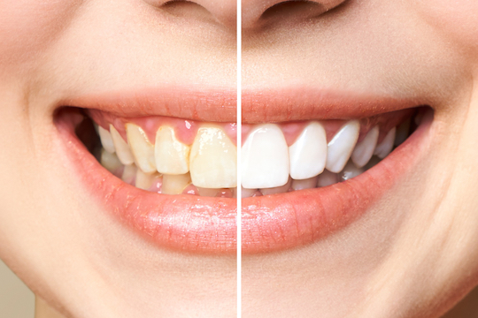 zoom whitening warrnambool