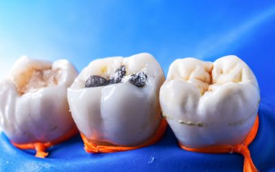 Choosing the Best Type of Dental Fillings in Warrnambool