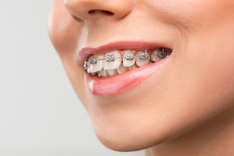 braces hygiene and care warrnambool