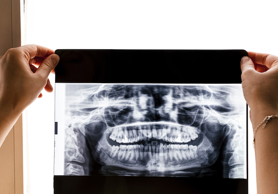 reasons for extracting wisdom teeth warrnambool