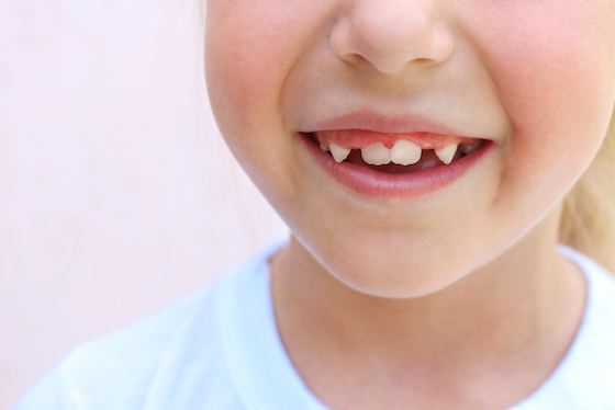 causes of crooked teeth warrnambool