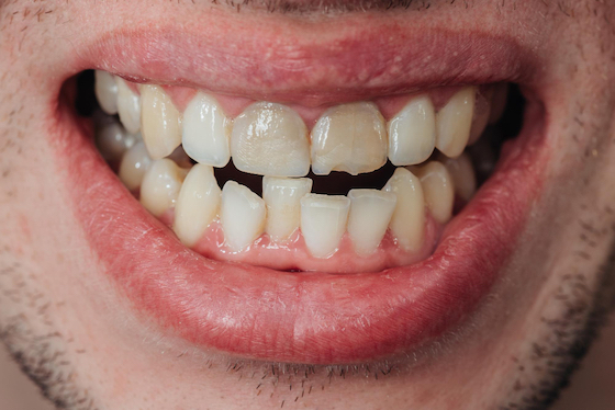 crooked teeth treatment warrnambool