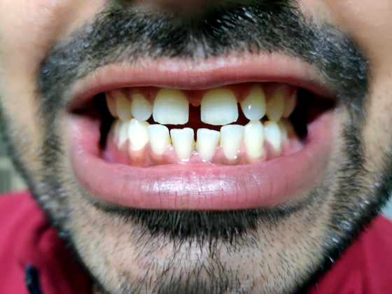 causes of teeth spaces gaps warrnambool