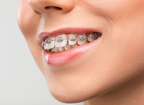 dental-braces-warrnambool