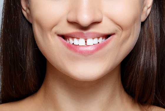 what are teeth spaces gaps warrnambool