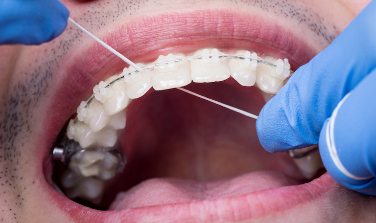 advantages of ceramic braces warrnambool