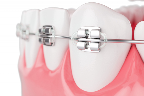 Fastbraces® vs. Traditional Braces - Thanasas Family Dental Care