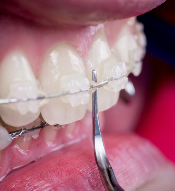 ceramic braces treatment and recovery expectations warrnambool