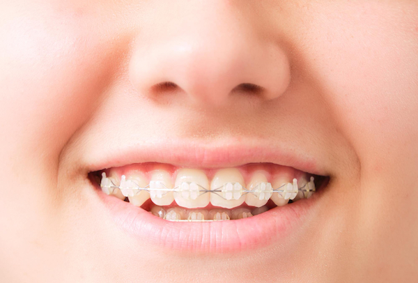 ceramic braces warrnambool