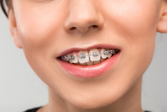 metal braces warrnambool