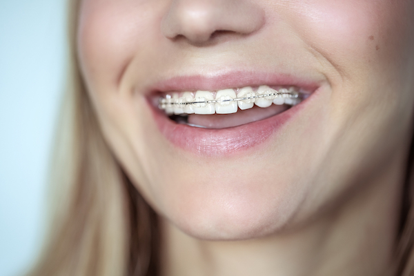 what are ceramic braces warrnambool