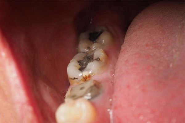 mercury fillings removal warrnambool