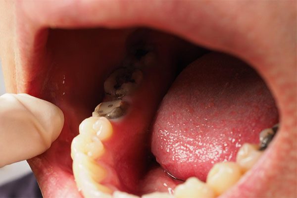 what are mercury fillings warrnambool