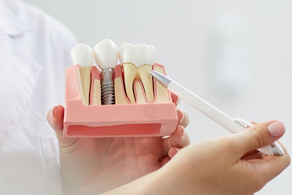 dental implants dentist warrnambool