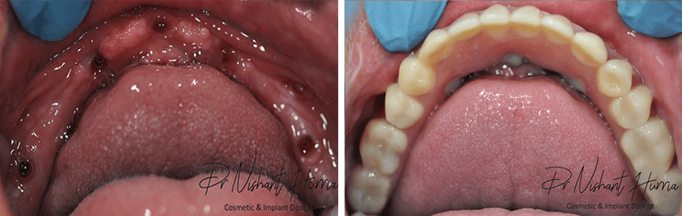 all-on-5-fixed-implant-prosthesis-before-and-after-dentist-warrnambool