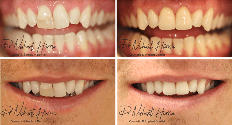 anterior-crowns-before-and-after-warrnambool