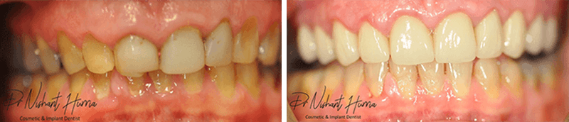upper full arch crowns and veneers before and after warrnambool