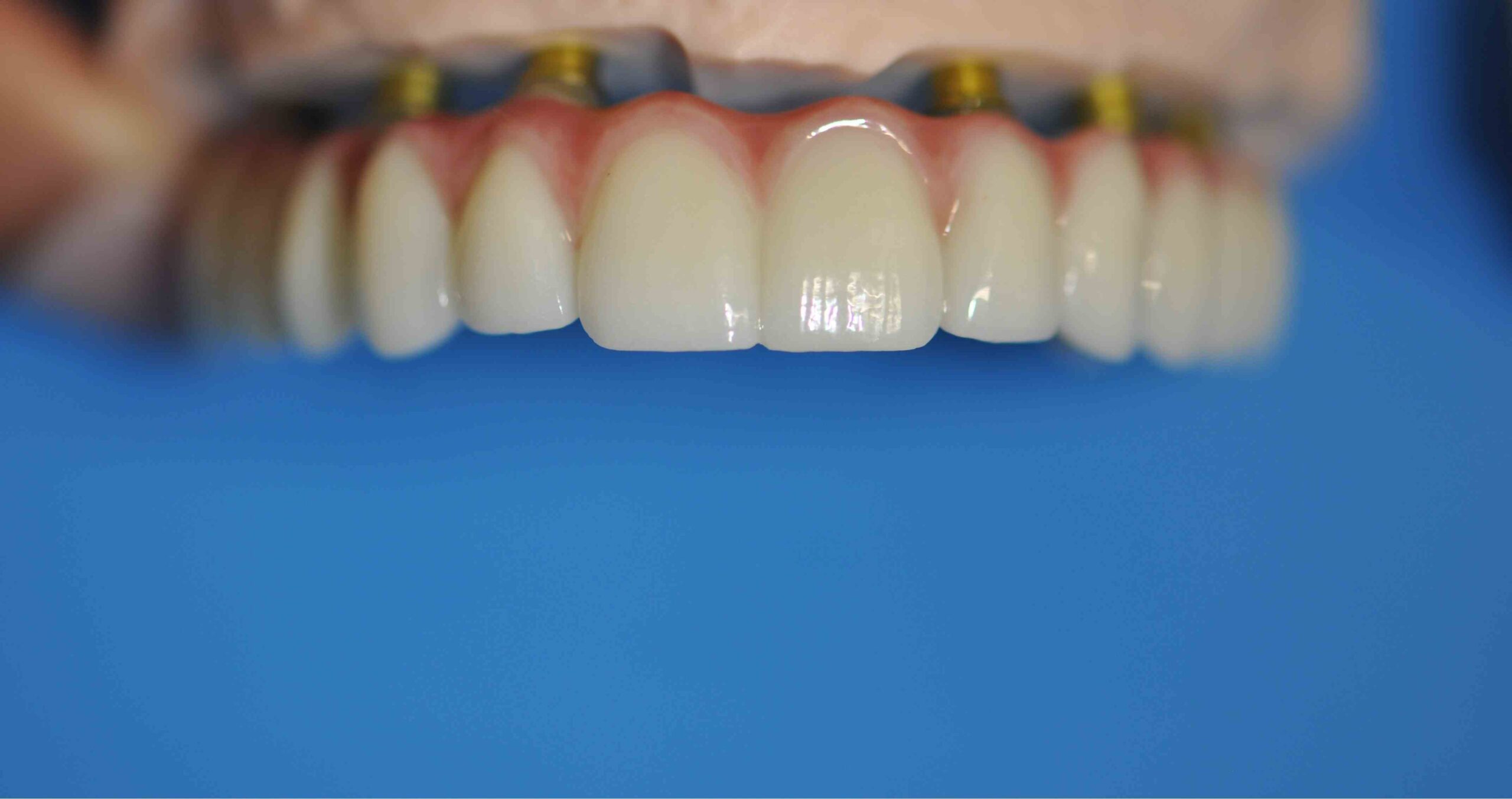 all-on-4 Dental Implants Warrnambool
